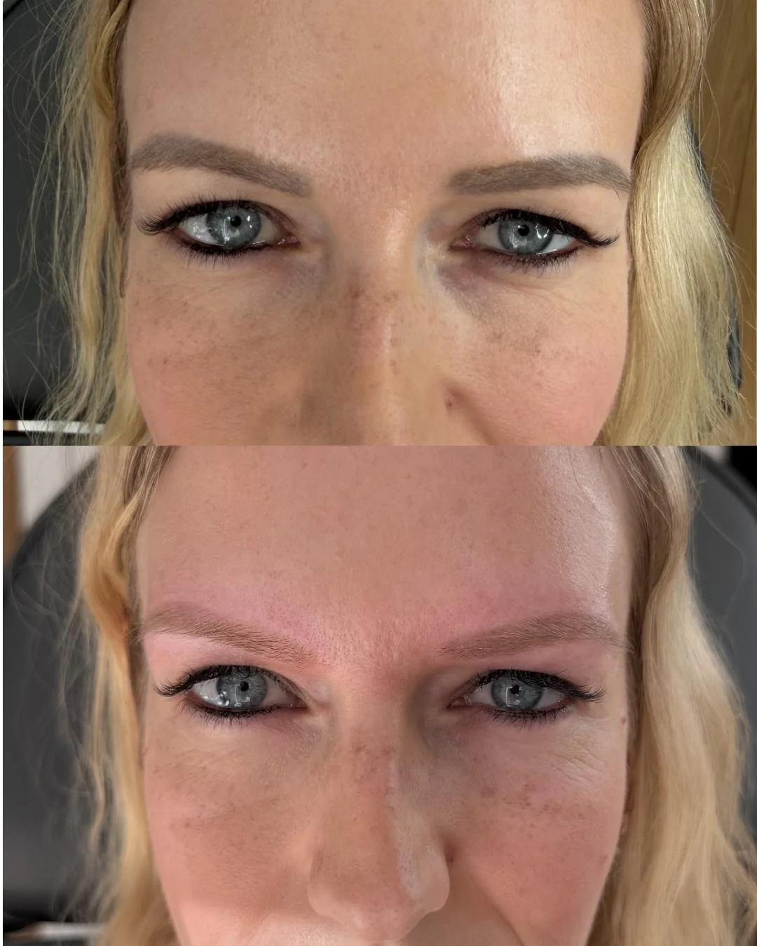 PMU Laser Removal 1 Treatment 