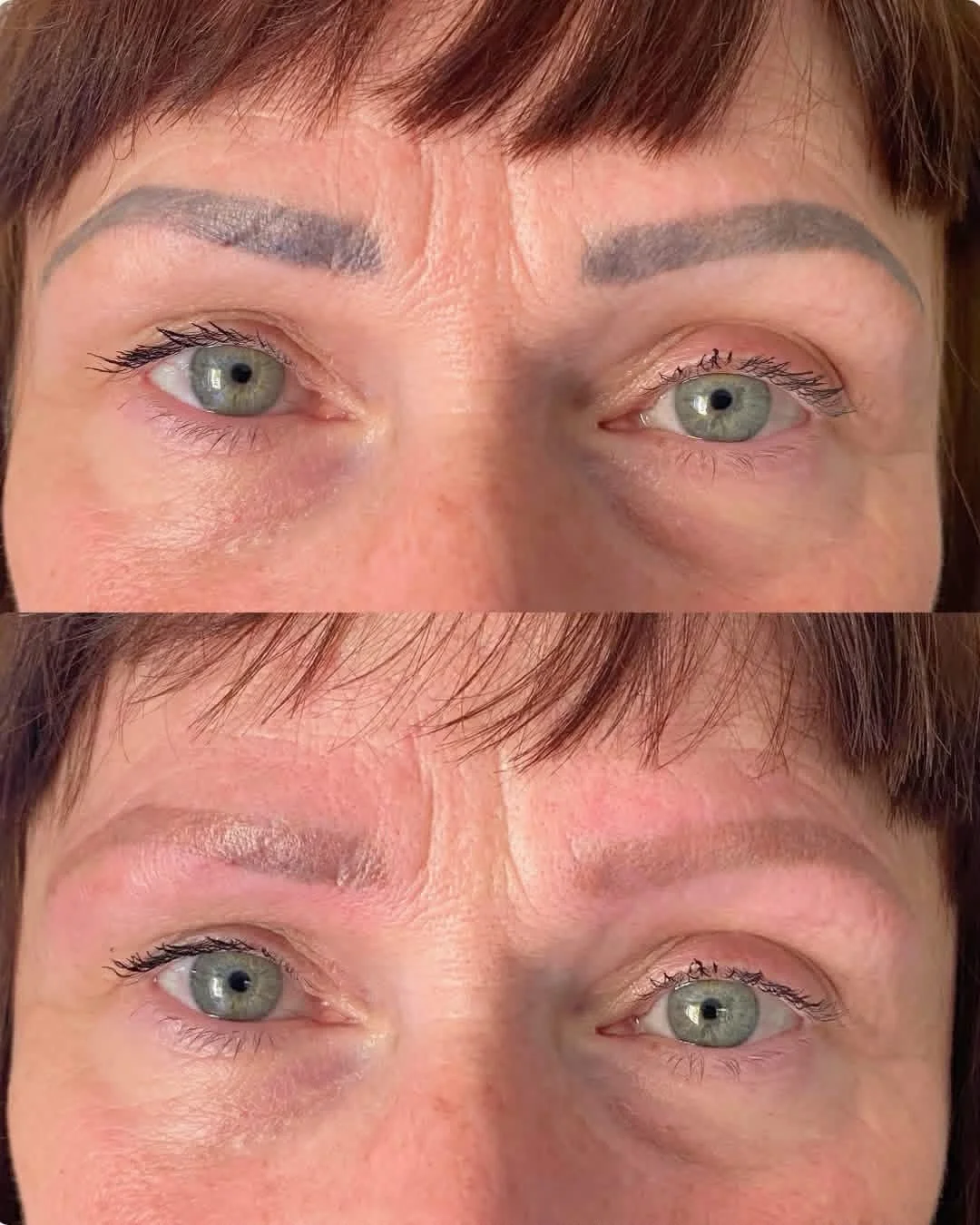Before & After 1 Laser removal Treatment 