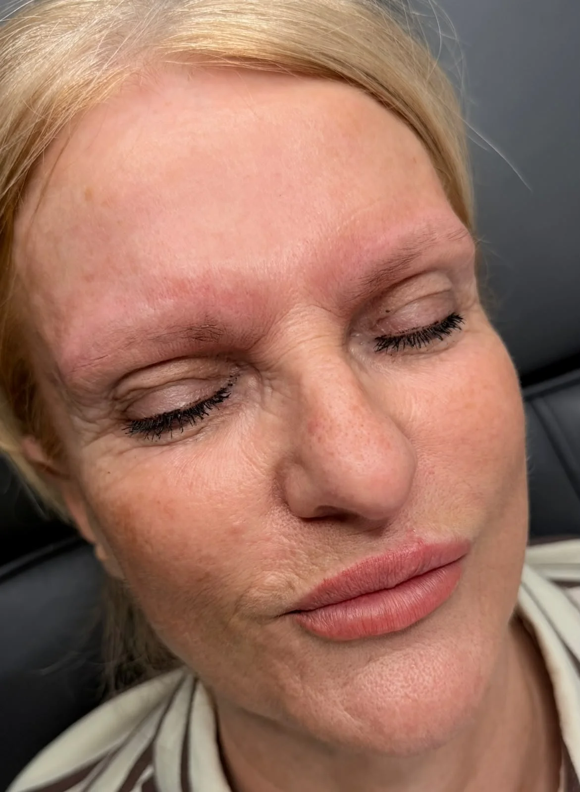  PMU Laser Removal /1 treatment 