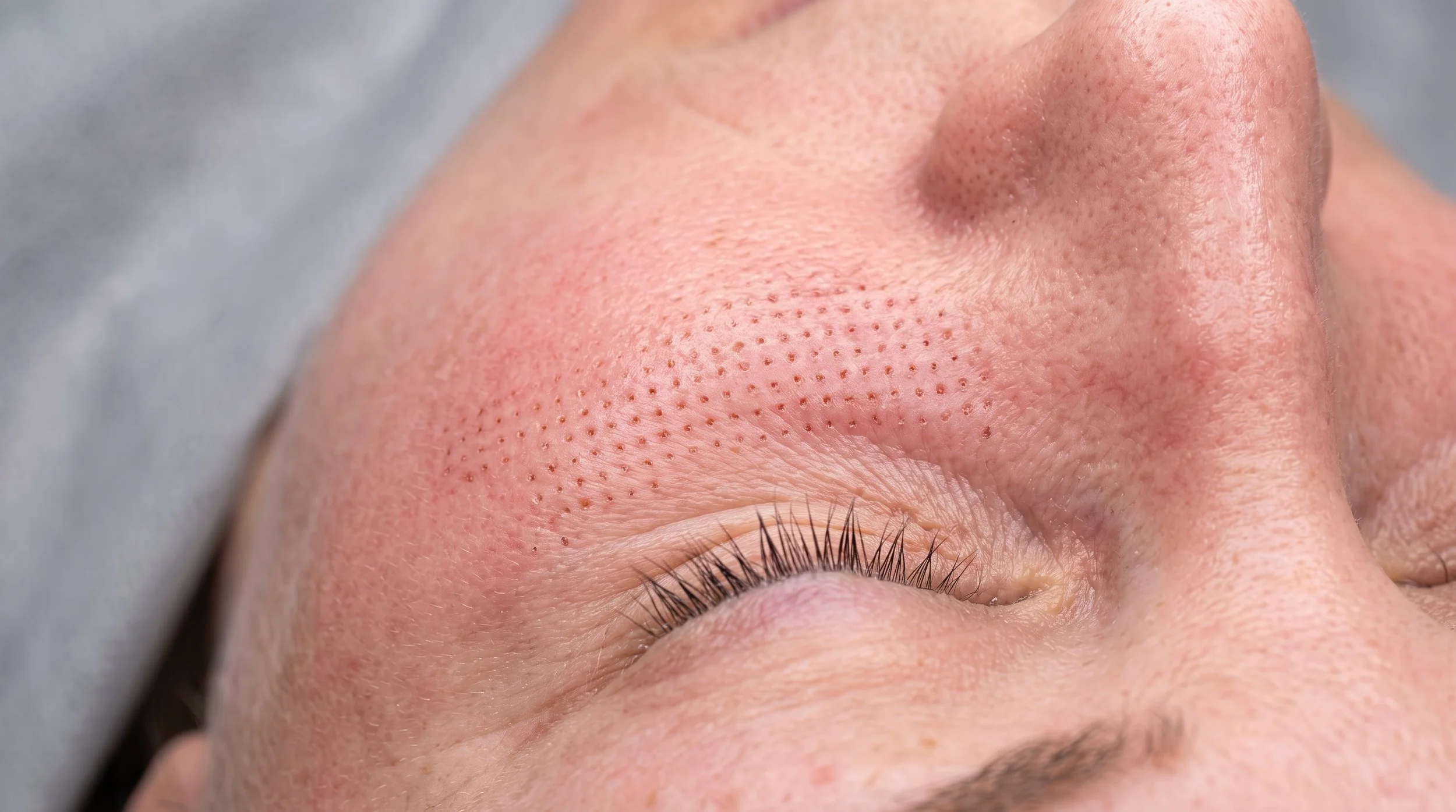 Fractional Laser Resurfacing: What You Need to Know