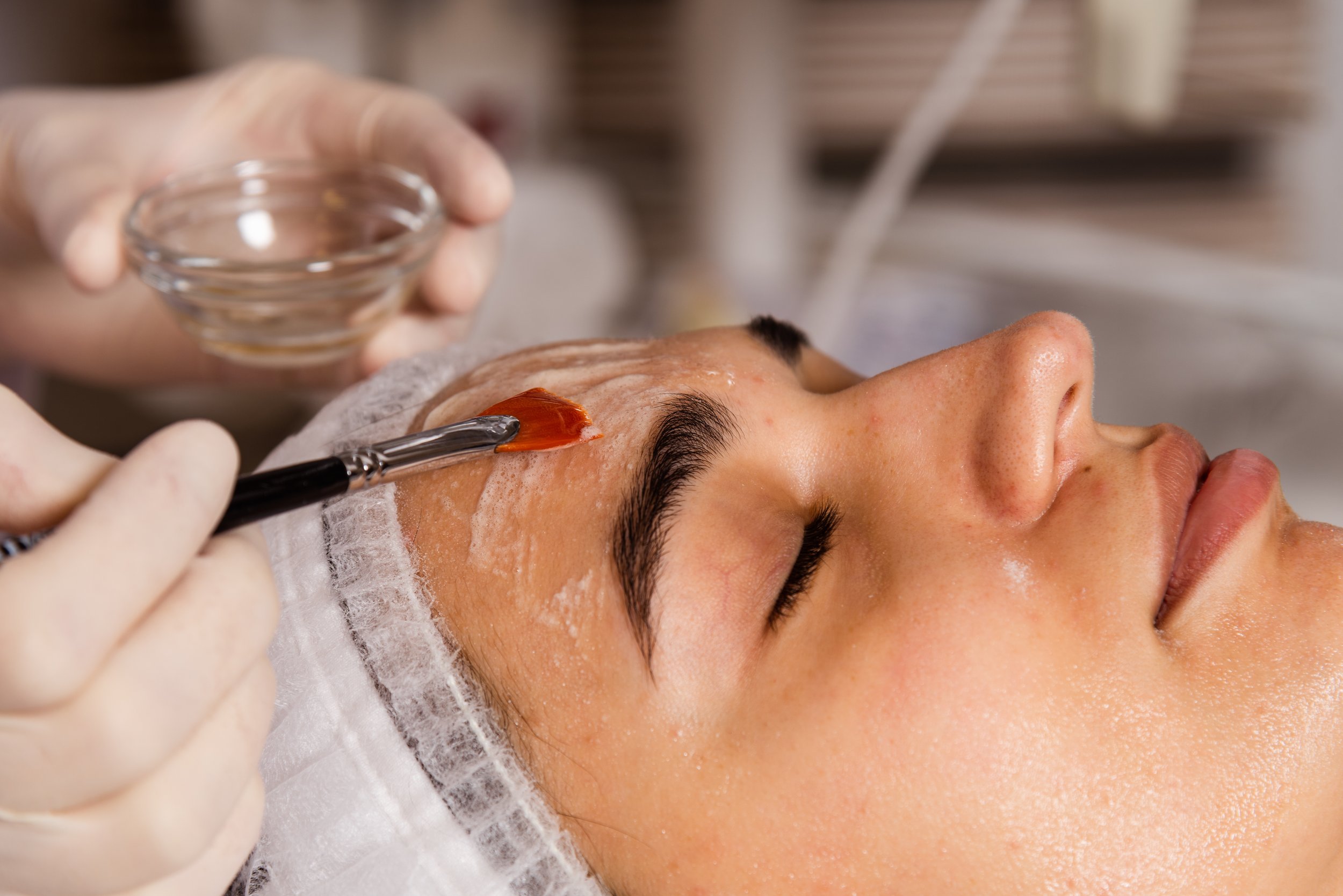 TCA Skin Peels. The strong ones.