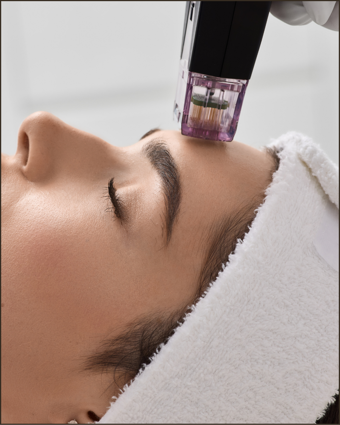 Medspa in Humble, TX 77396 l Microneedling Near Me