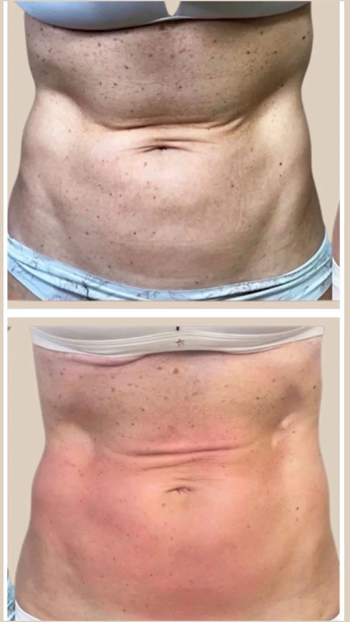 GLP-1 weight loss support with advanced technology for belly tightening before and after immediate results