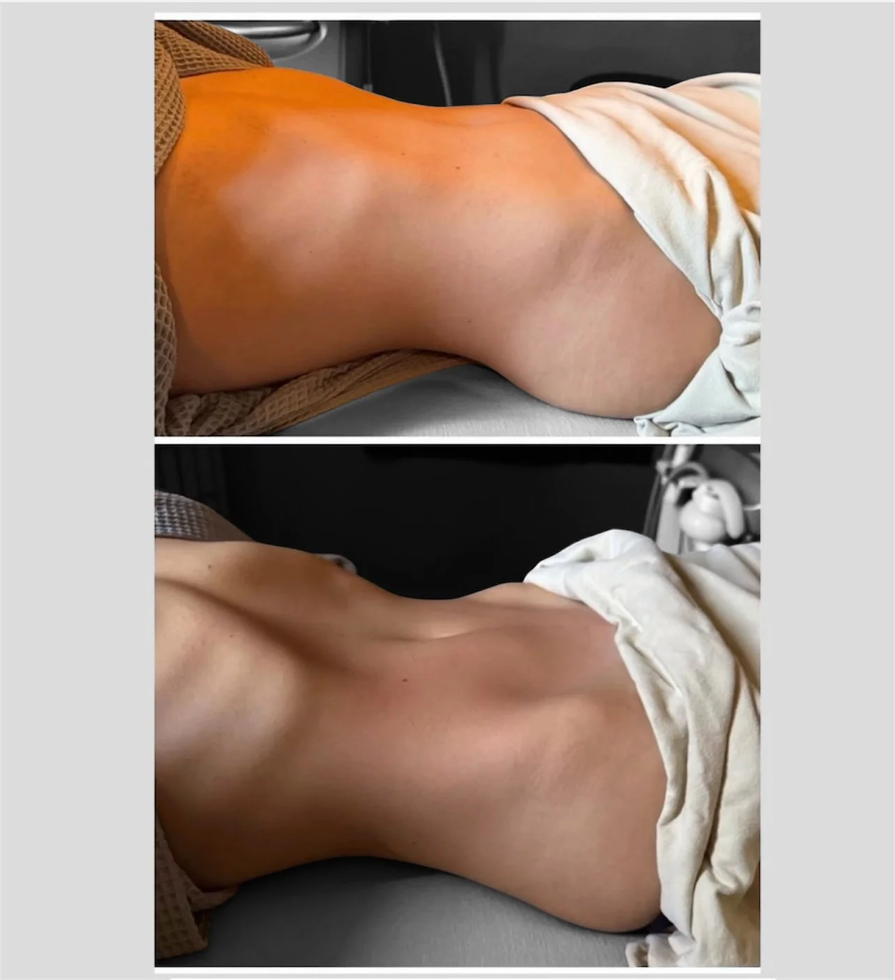 Before and after results of a targeted single zone manual lymphatic drainage massage to deeply decongest the abdomen and flatten the midsection in West Hollywood