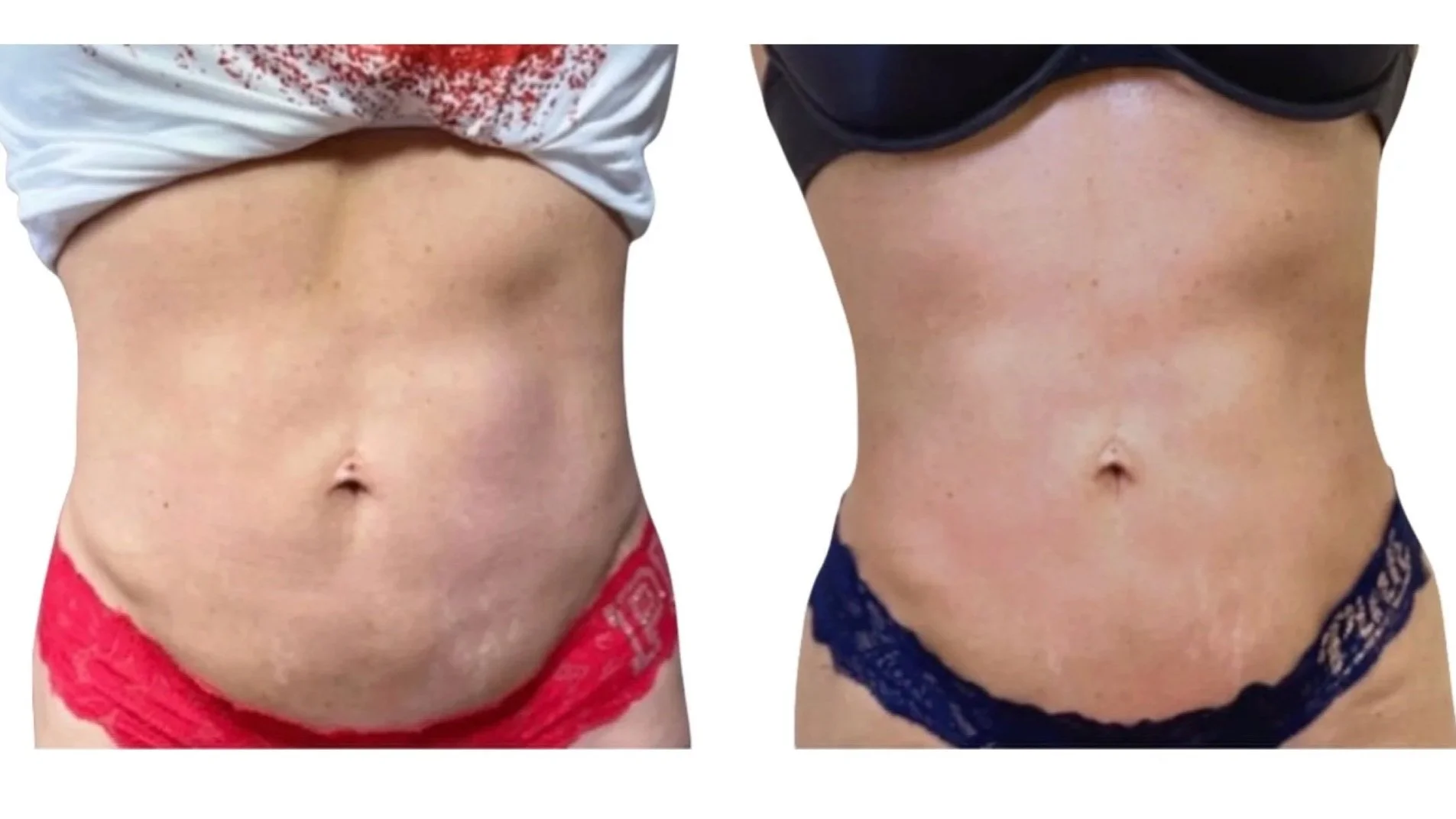 Post-op fibrosis recovery and surgical lump smoothing combined with manual lymphatic drainage massage in West Hollywood