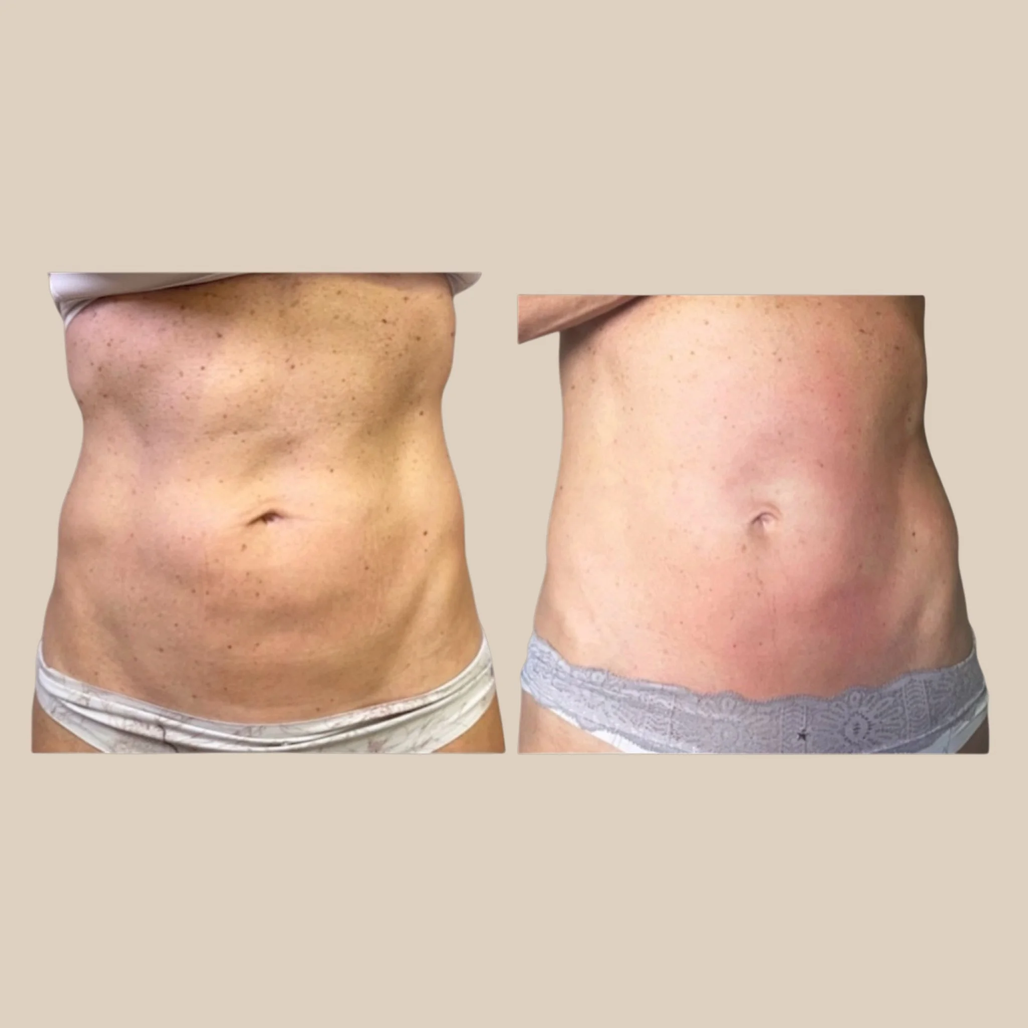 Stomach skin remodeling and belly button area tightening combined with manual lymphatic drainage massage