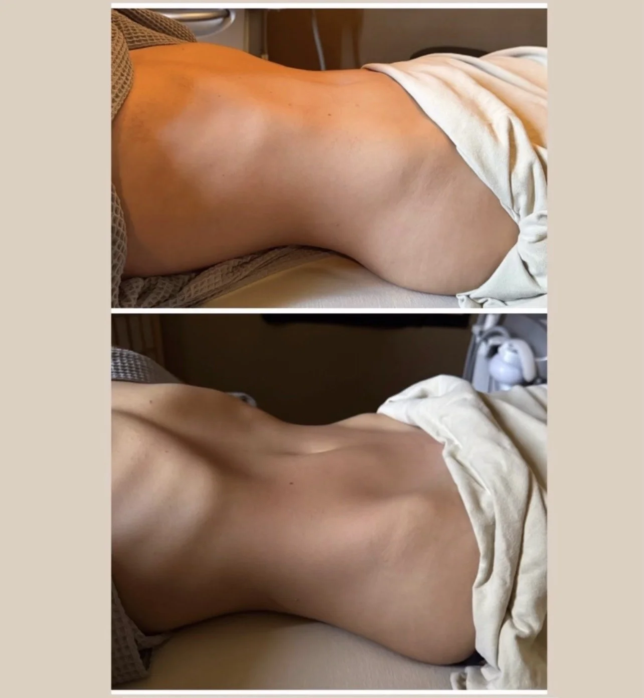 Manual lymphatic drainage massage before and after immediate results