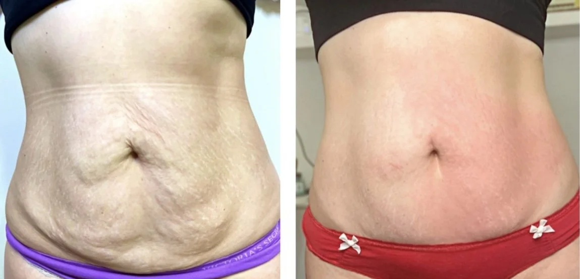 Advanced lymphatic drainage enhancements and skin tightening treatment results