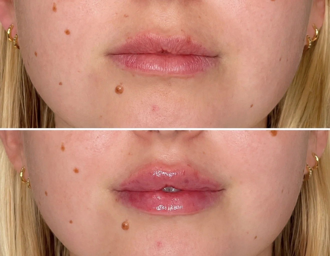 Close-up of a woman's face showing a before-and-after comparison of lip enhancements, with noticeable increase in lip volume and shine in the after image
