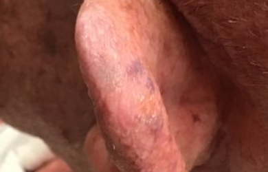 Follow Up Ear Closeup