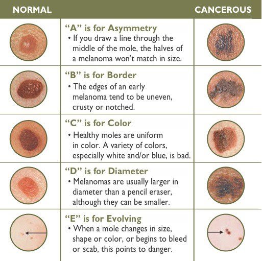 ABCDE infographic to evaluate signs of skin cancer