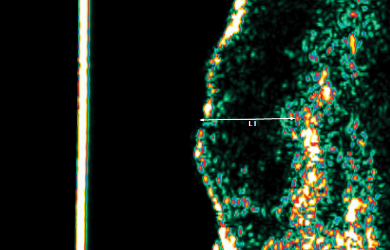 Mid Treatment Ultrasound