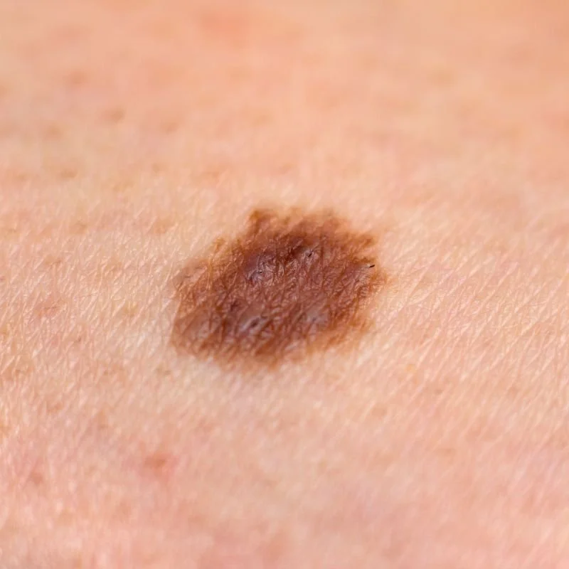 melanoma on the body