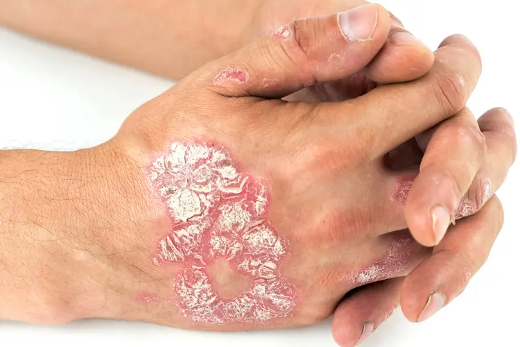 Psoriasis on hands