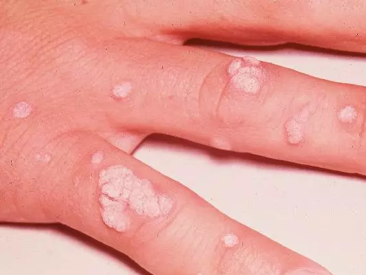 warts on a person's hand