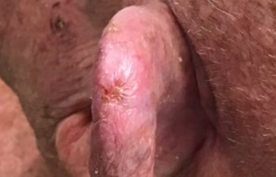 Mid Treatment Ear Closeup