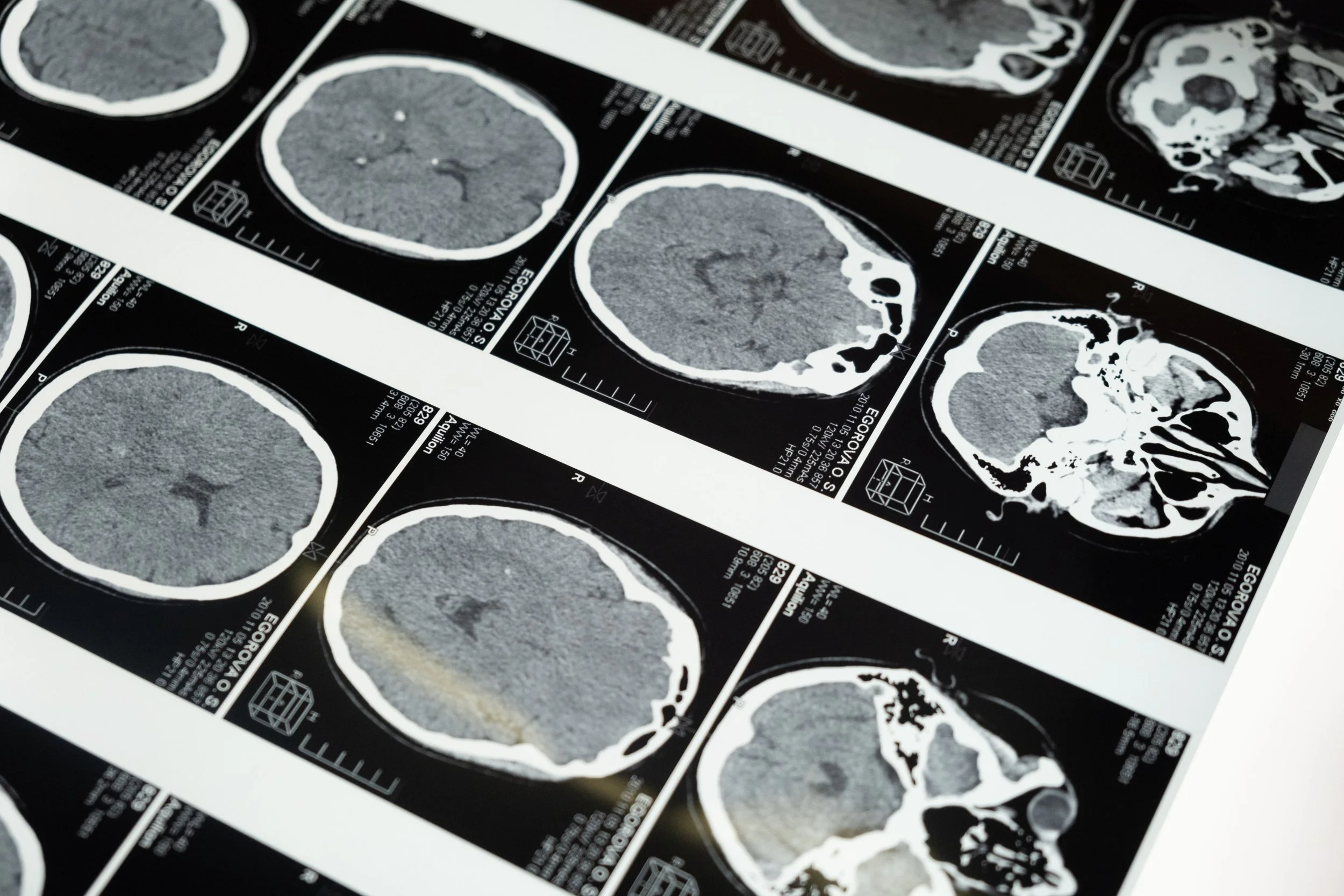 Multiple black and white medical images of brain scans laid out on a surface.