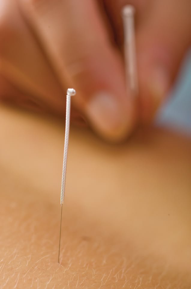 Close-up of an acupuncture needle inserted into skin, with fingers holding other needles in the background.