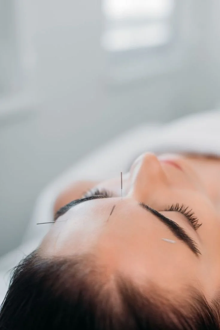 Neuroacupuncture sessions