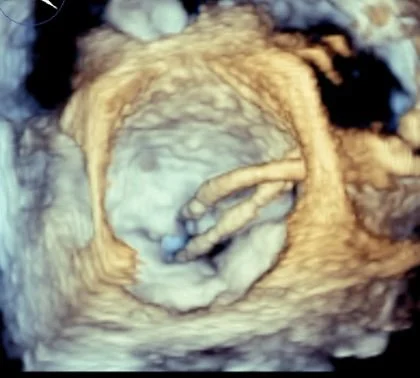 Toronto Interventional Echo Summit (TIES) participants gathered around an echocardiography system as an instructor points to a 3D cardiac image on the monitor.