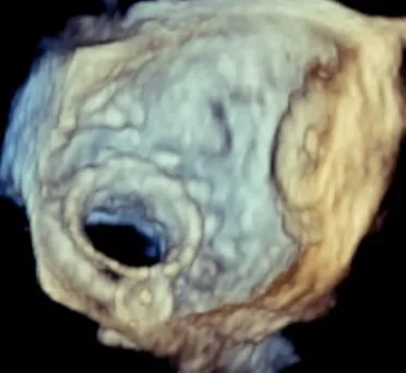 3D echocardiography image of a heart valve displayed during the Toronto Interventional Echo Summit (TIES).