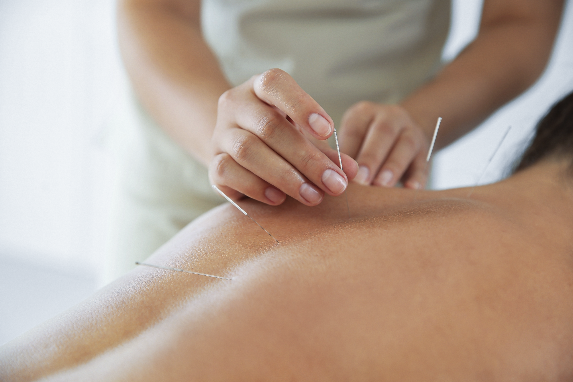 A person receiving acupuncture, with multiple thin needles inserted into their back. The practitioner is adjusting a needle with their hand.