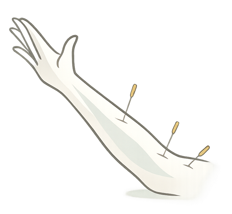 Illustration of acupuncture treatment with needles placed in the forearm