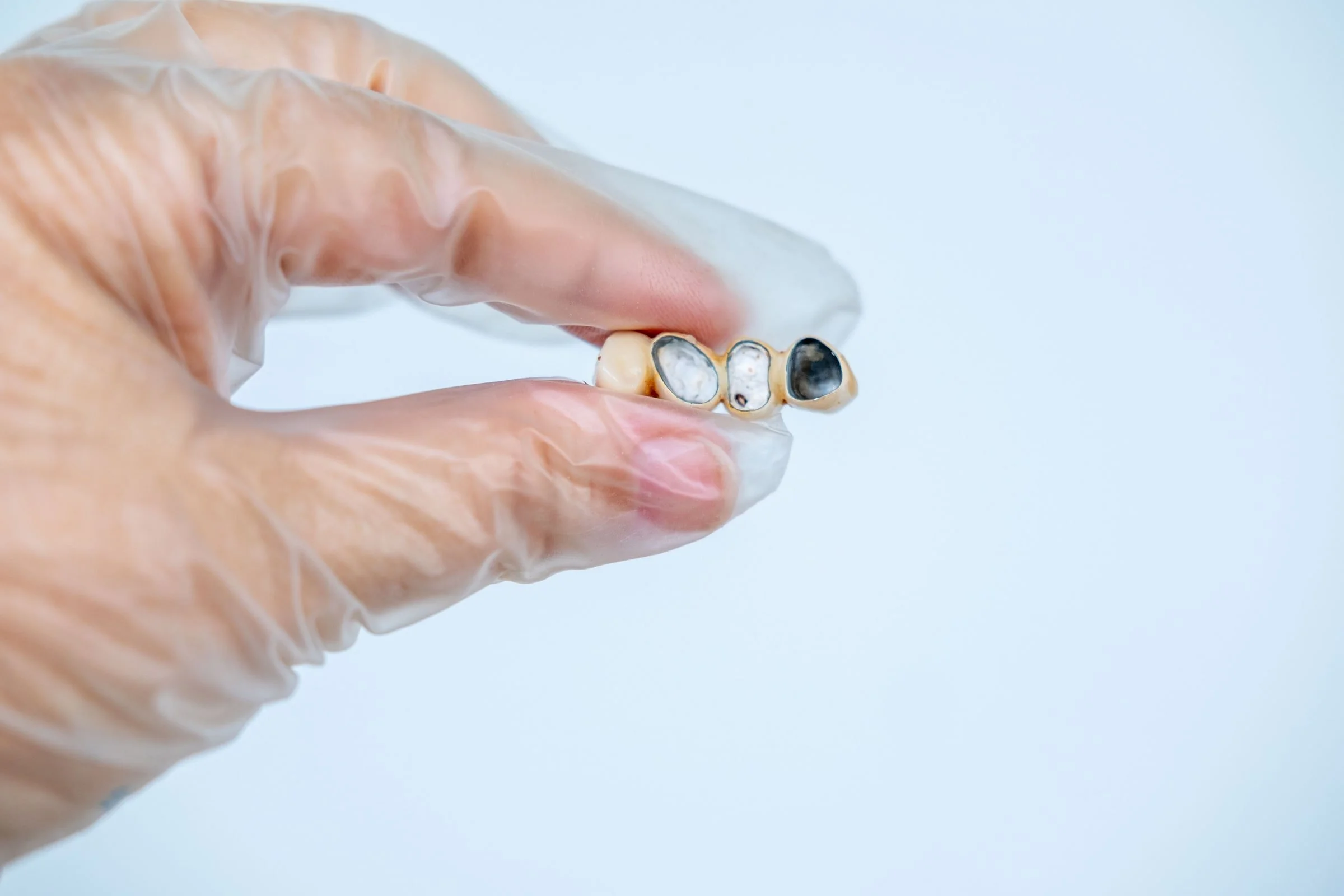 Gloved hand holding a dental bridge with metal restorations