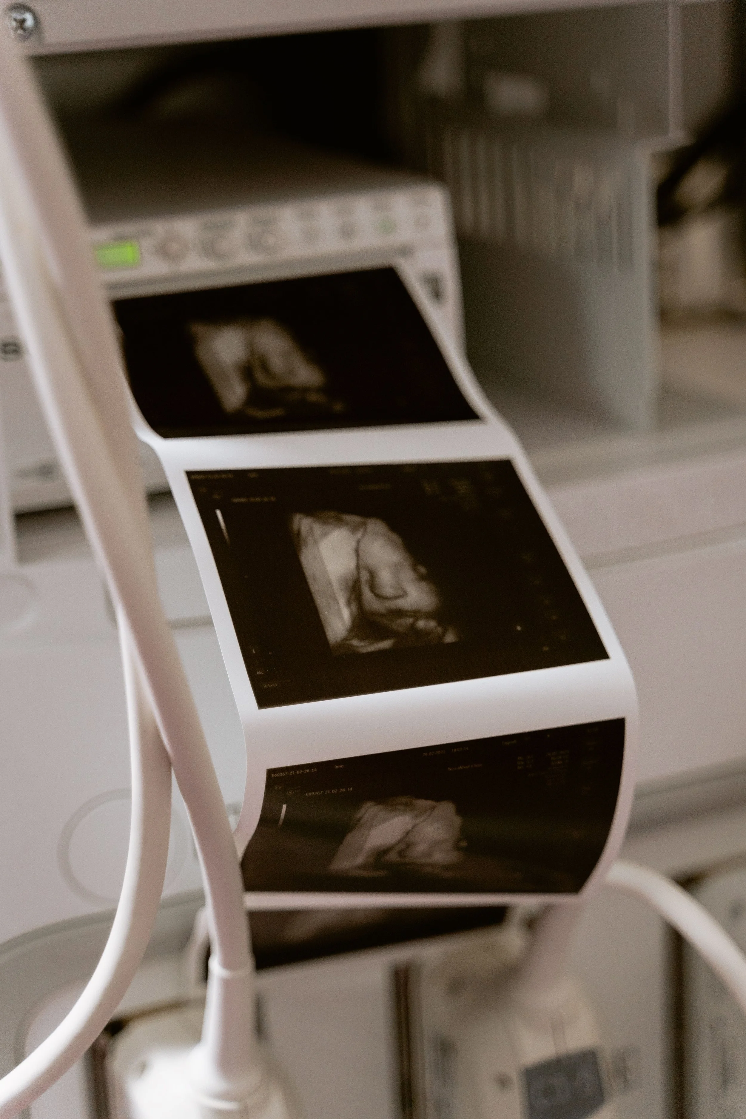Close-up of ultrasound images hanging from a white stand in a clinical setting.