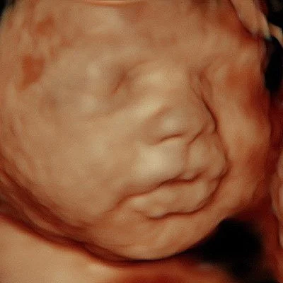 A 3D ultrasound image of a sleeping baby's face.