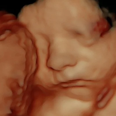 Close-up of a newborn fetus with facial features, eyes closed, and hands near face.