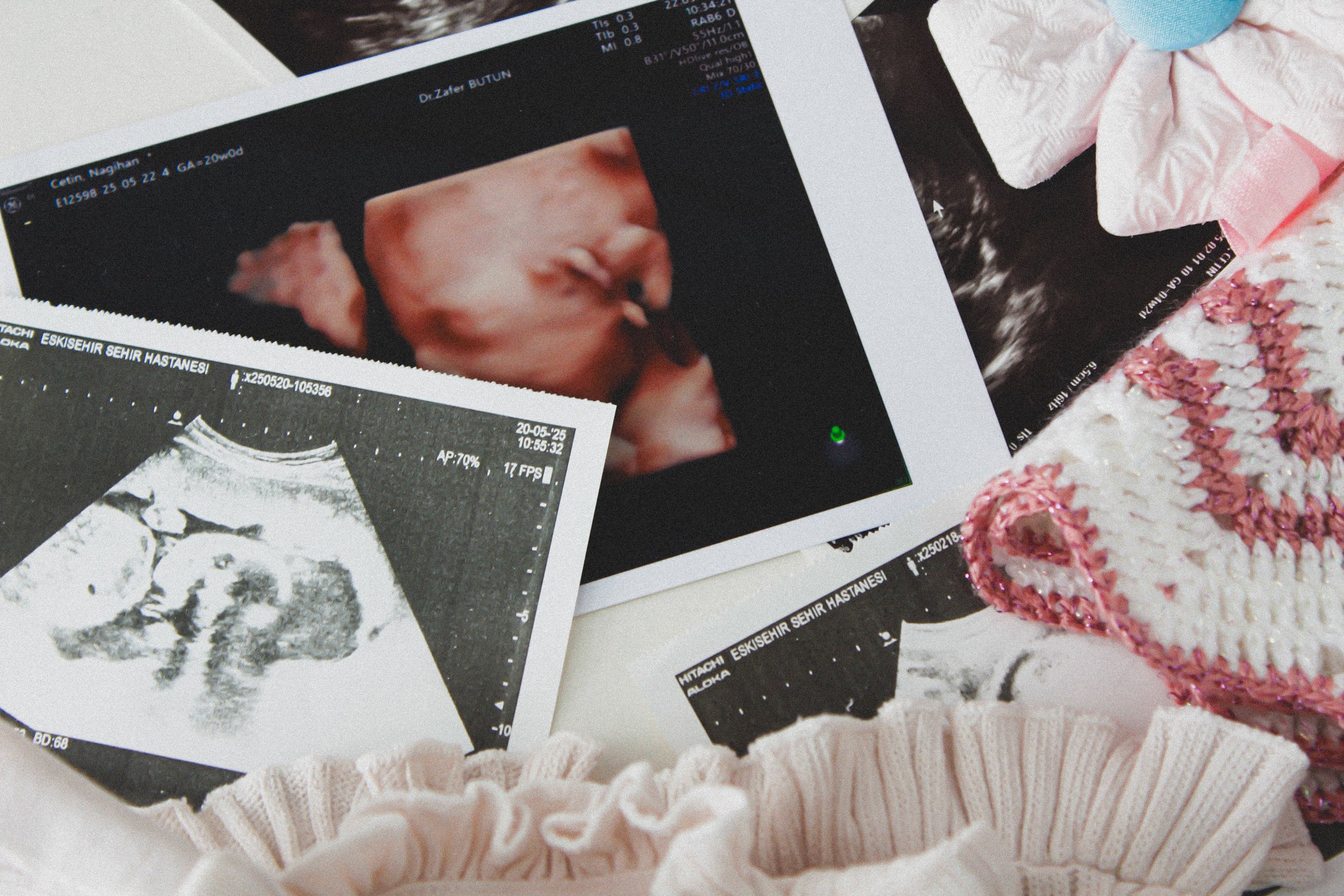 Ultrasound images and a 3D ultrasound of a fetus on a table, with a pink decorative item and a lace-like fabric underneath.