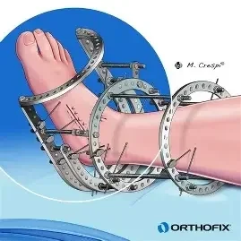 Illustration of a foot with metal medical devices and surgical markings indicating orthopedic surgery or alignment correction.