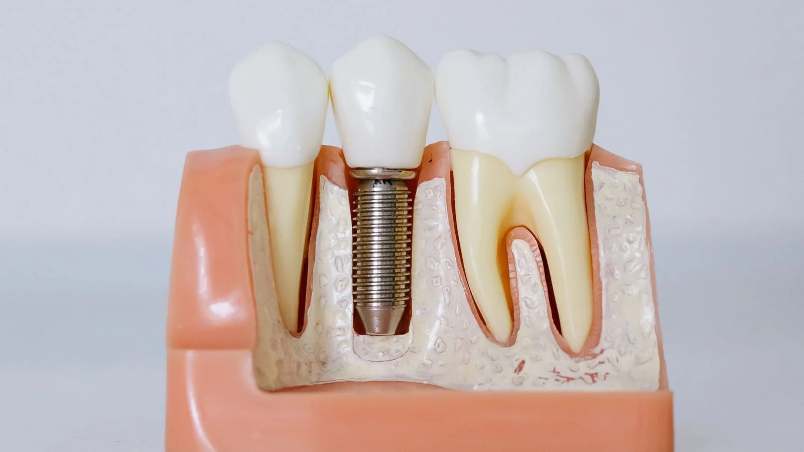 &nbsp;Dental Implant Q&amp;A