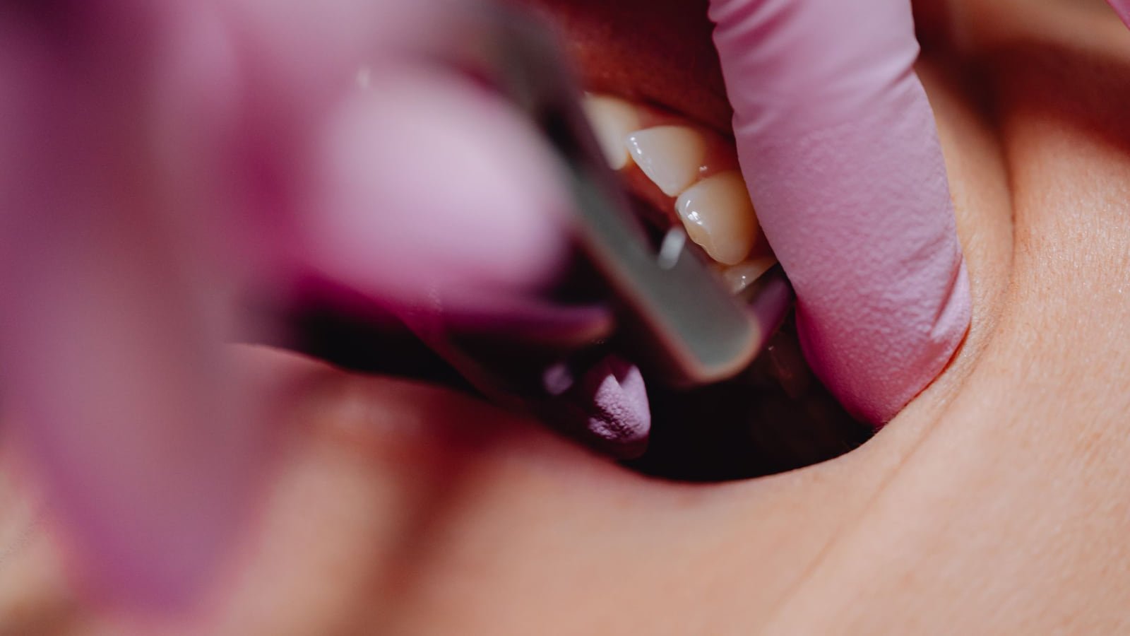 Gum Disease: Signs and Treatment