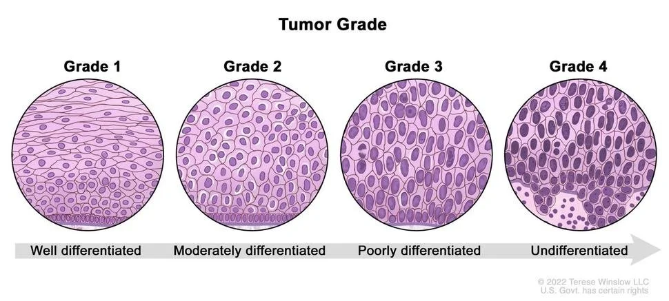 What is metastatic renal cell carcinoma?