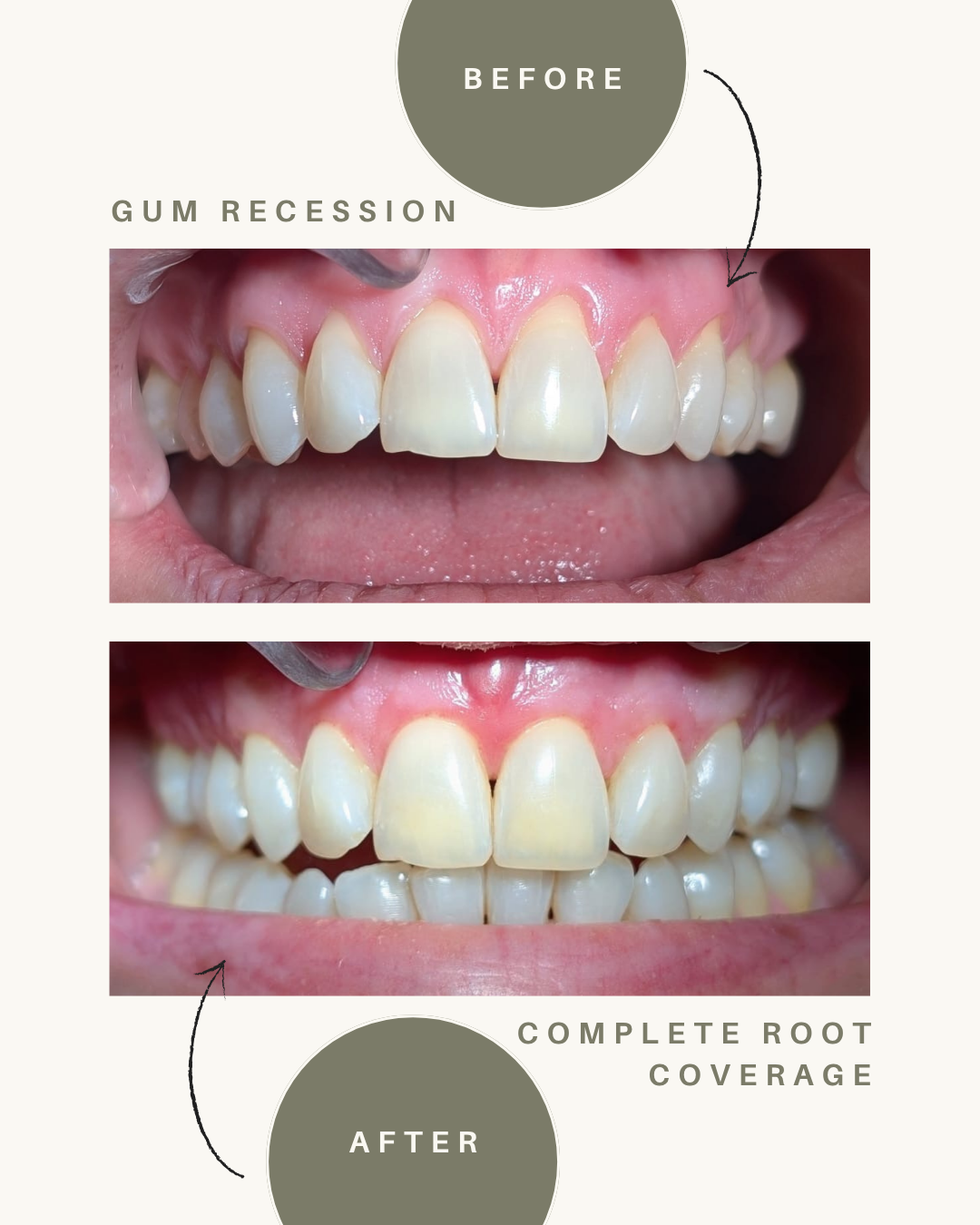Before-and-after frontal smile showing treatment of gum recession with root coverage.