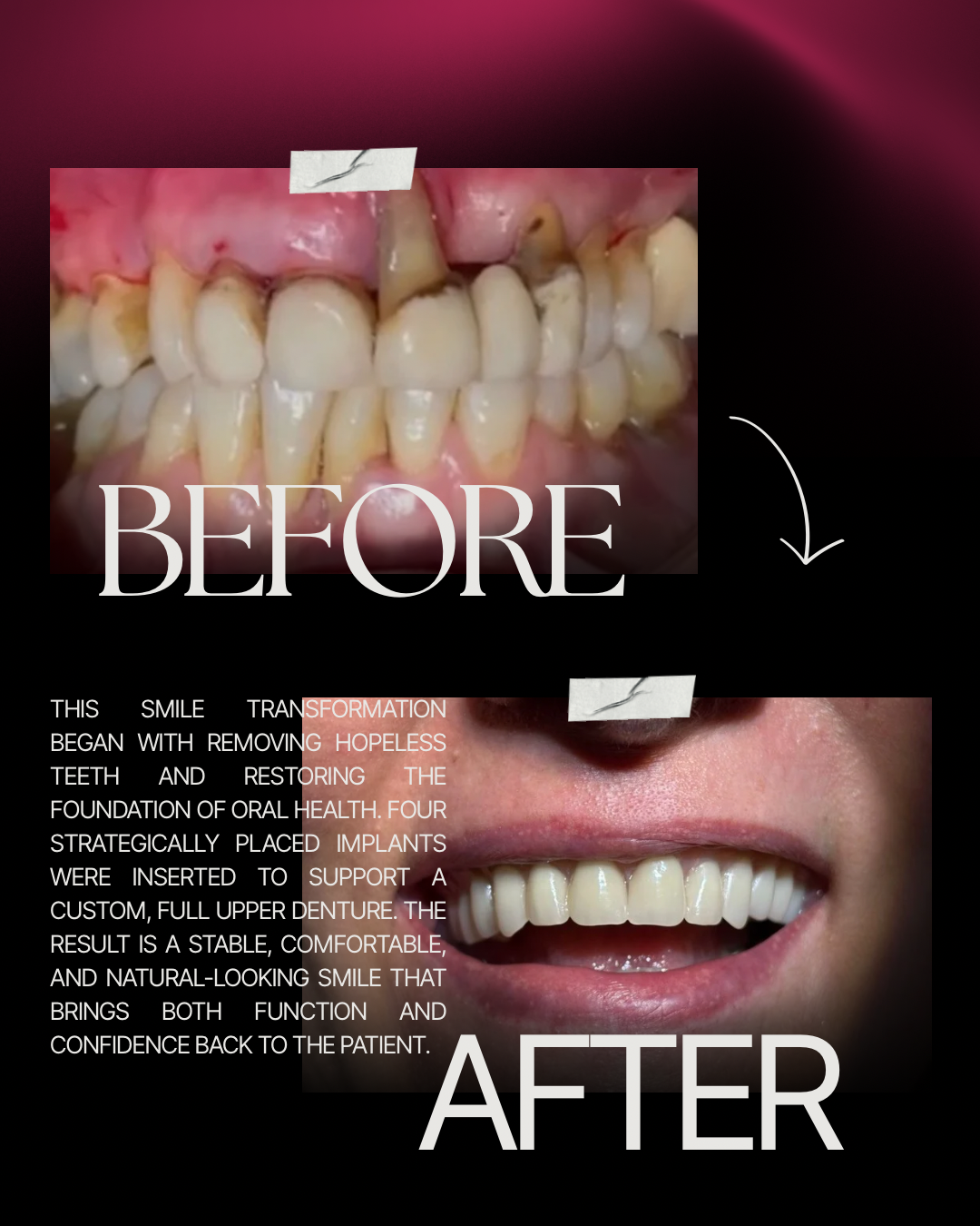 Before-and-after smile showing replacement of failing upper teeth with an implant-supported full-arch denture.