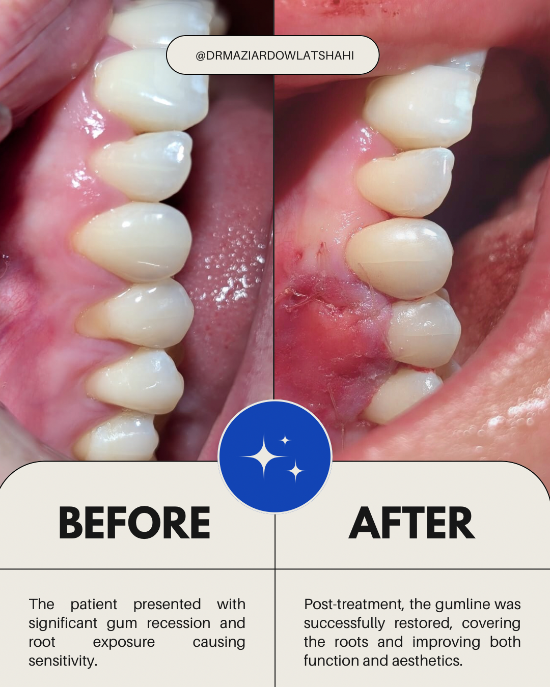 Before-and-after side view showing treatment of gum recession and exposed tooth roots.
