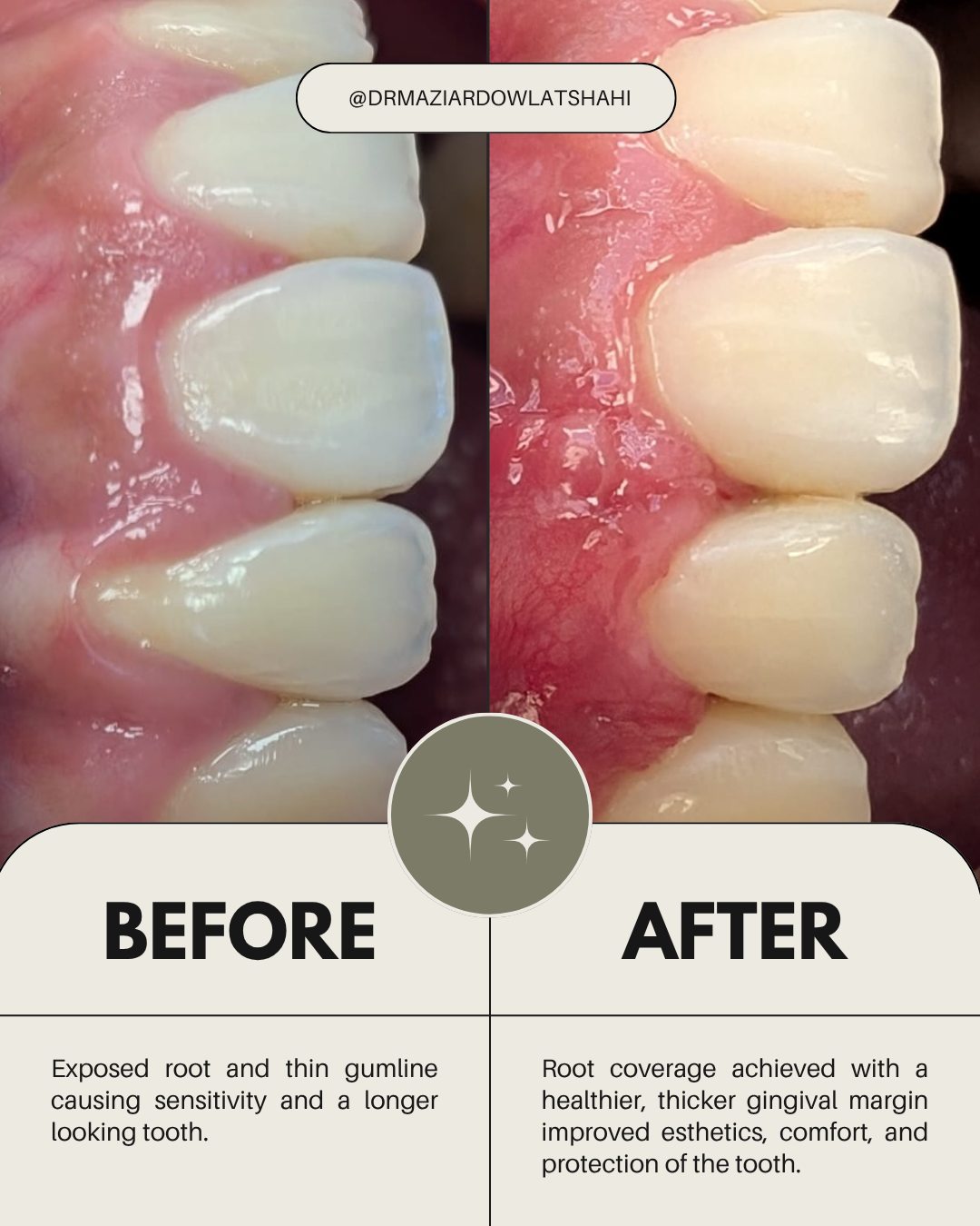 Close-up before-and-after image showing root coverage and a thicker gum margin around the treated tooth.