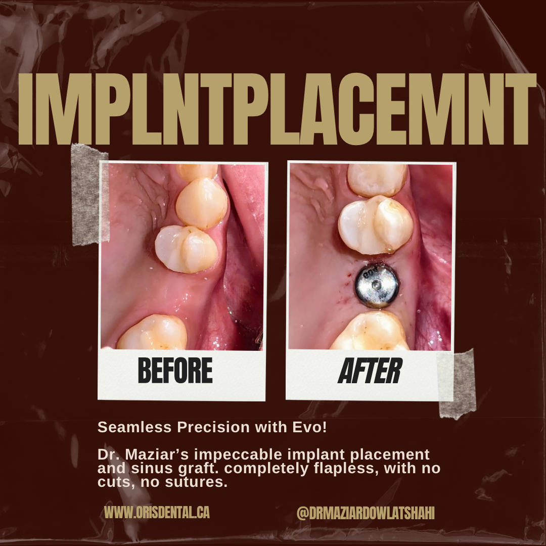 Before-and-after clinical images showing EVO-guided dental implant placement in a missing-tooth area.