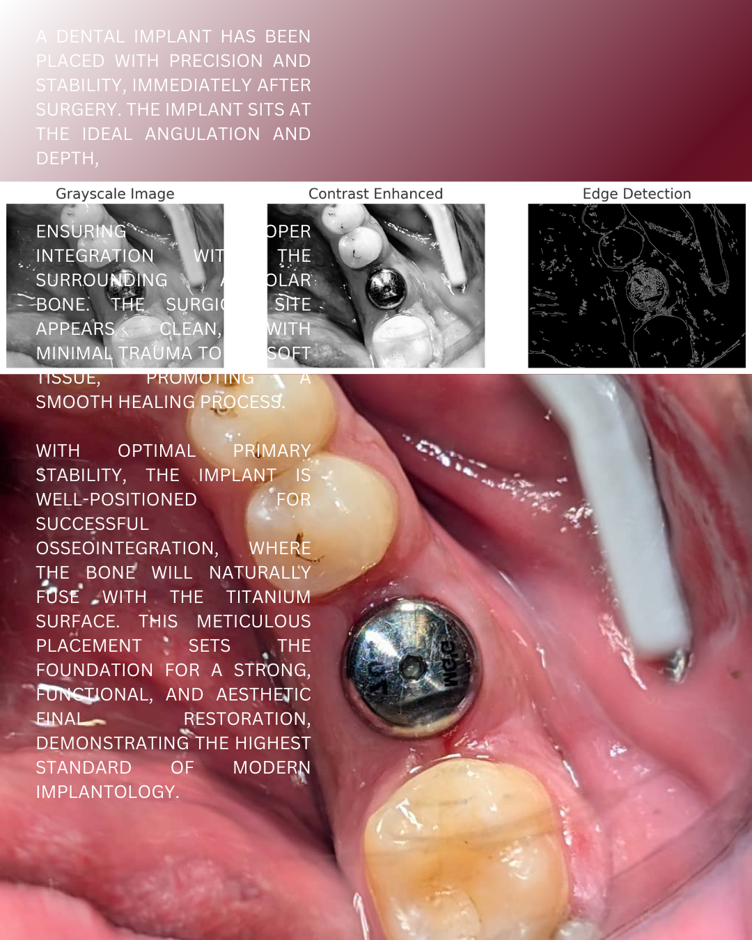 Clinical implant case showing imaging analysis and precise placement of a dental implant.