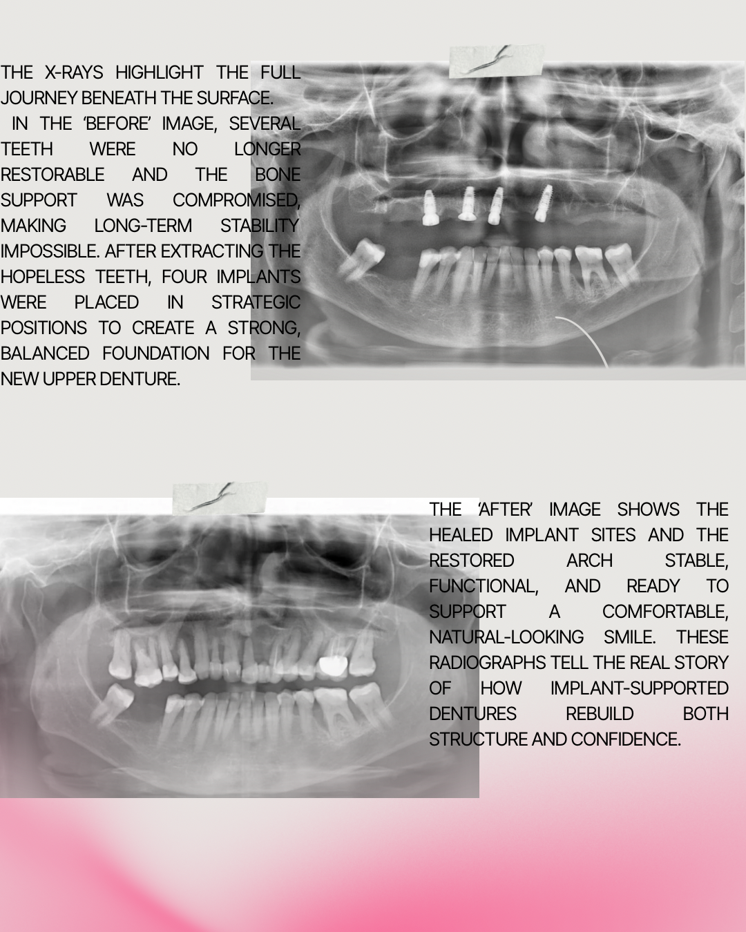 Before-and-after panoramic radiographs showing upper full-arch treatment supported by dental implants.