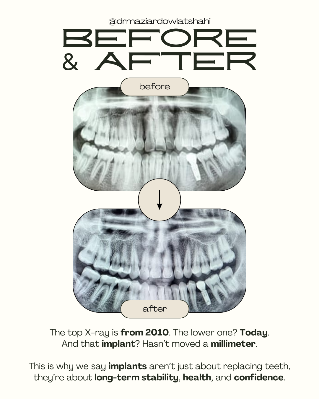 Before-and-after panoramic dental radiographs showing implant treatment and restored missing teeth.