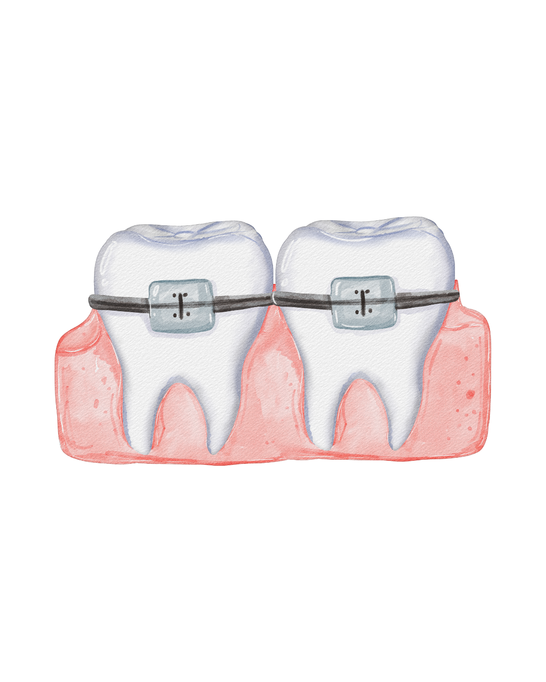 Illustration representing Invisalign clear aligner treatment at Fort Dental Clinic.