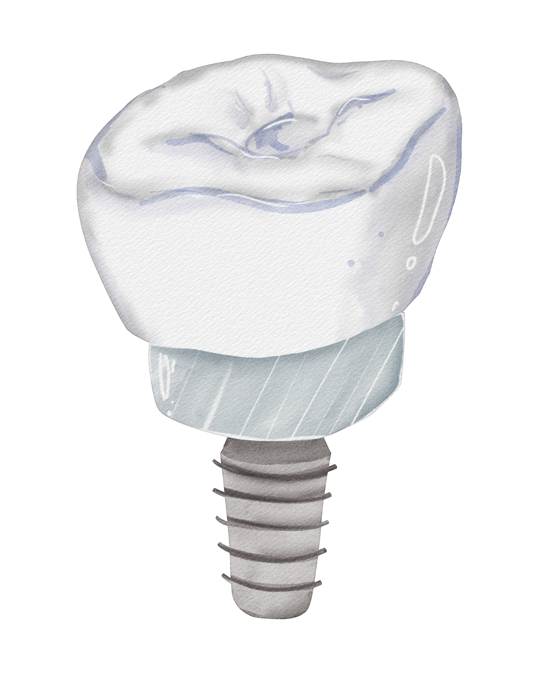 Illustration representing dental implant treatment at Fort Dental Clinic.