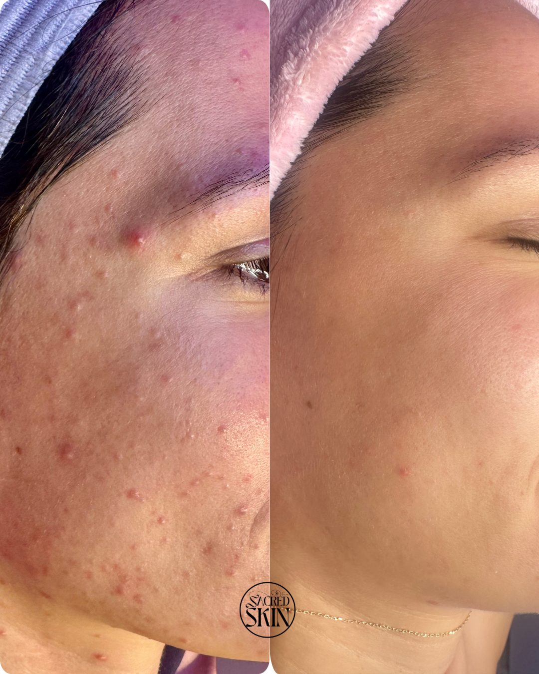 Side-by-side comparison of a woman's cheek showing acne before and after skin treatment. Left side shows inflamed pimples and redness, right side shows clear, smooth skin.