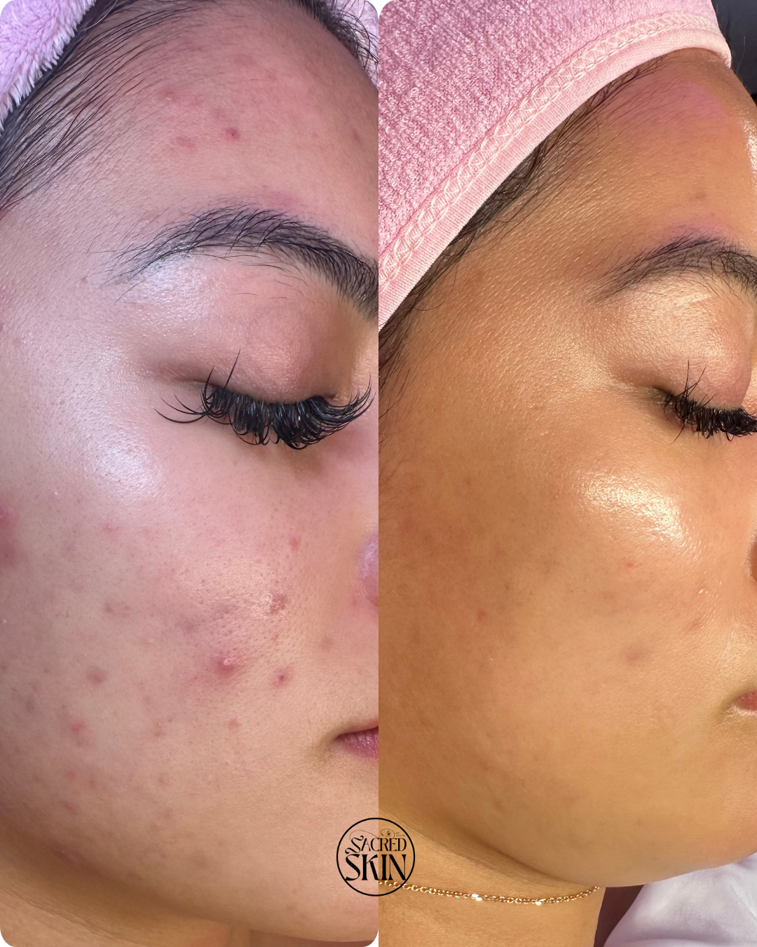 Side-by-side comparison of a woman's face showing acne before and after skincare treatment, with clear skin and radiant glow in the after photo.