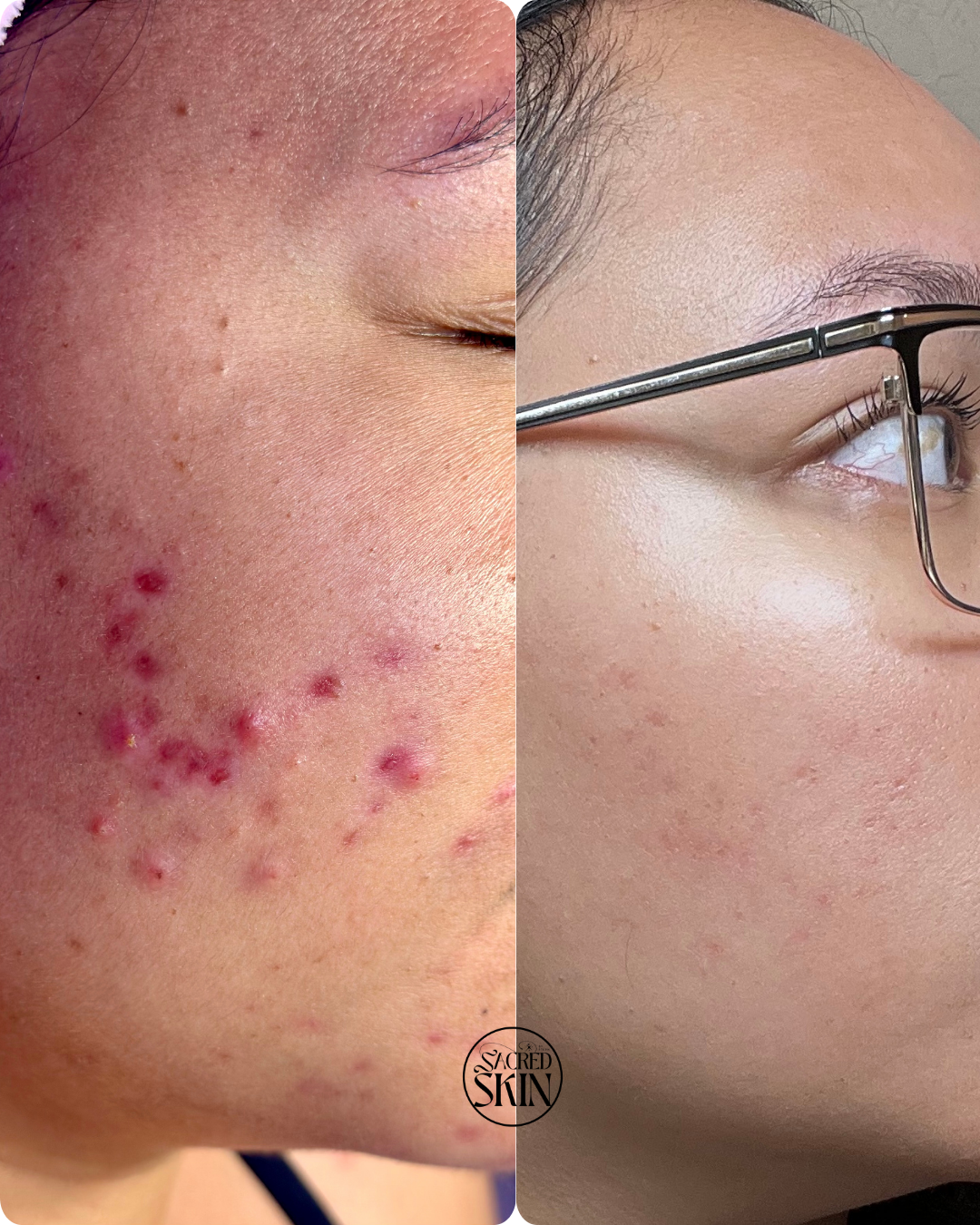 A split image showing a person's face before and after skin treatment. The left side displays the face with acne, pimples, and redness. The right side shows clear, smooth skin with no visible acne.