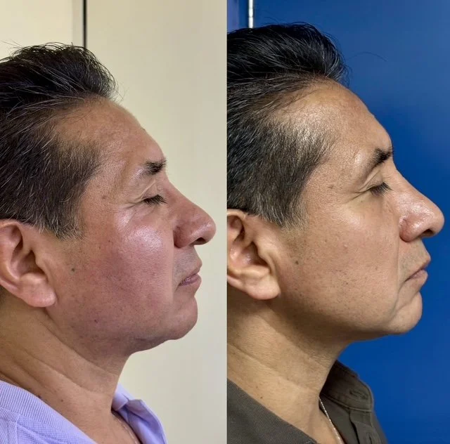 Comparación de perfil de un hombre antes y después de un tratamiento o procedimiento, con cambios visibles en su piel y contorno facial.